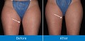 Varicose Veins Bergen County